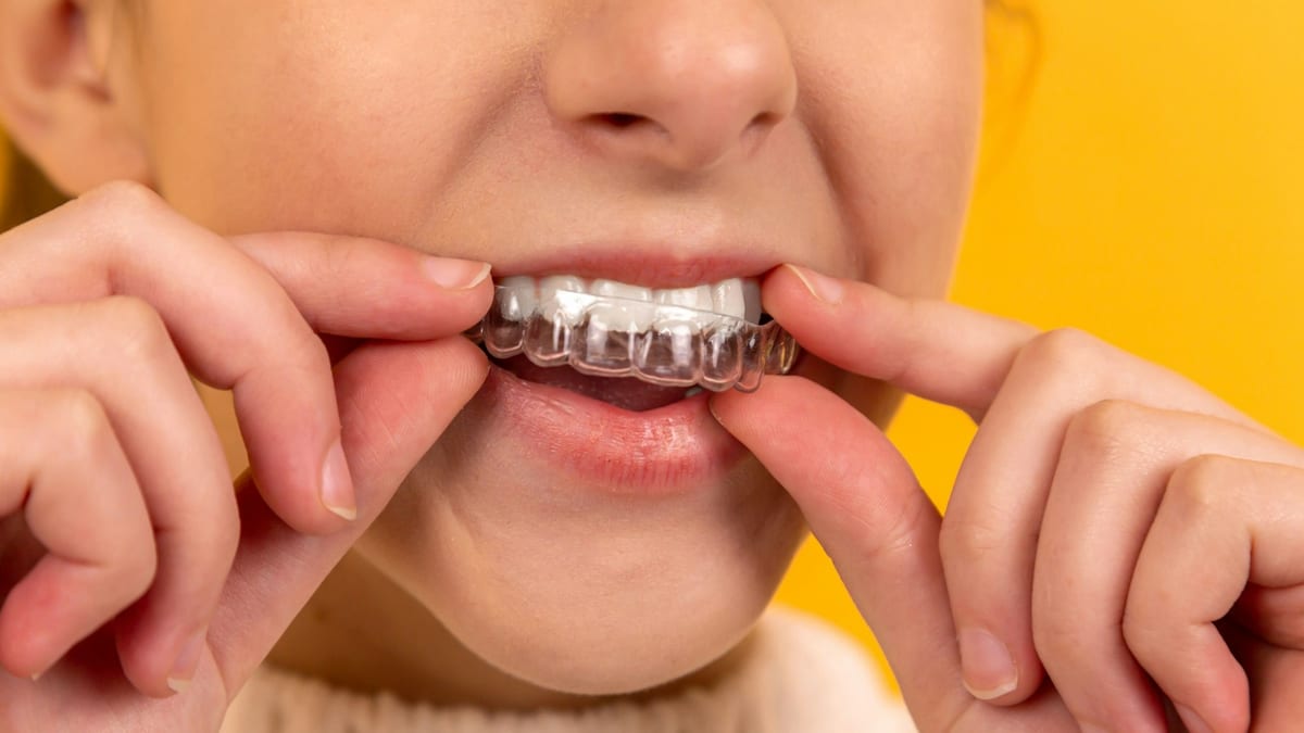 Clear Aligners vs Braces: Which Is More Effective?