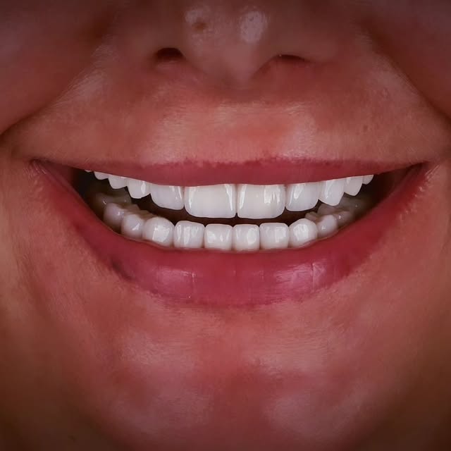 "Let your smile be the sunshine on a cloudy day." . . . . . #dentaltreatmentturkey #smilemakeoverturkey #emax #veneers #compositeveneers #compositebon