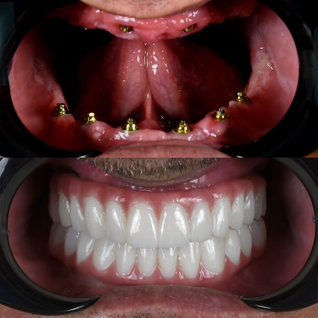 ✨ Full-Mouth Restoration Case ✨  In this case, we completed a full-mouth rehabilitation with 6 implants in the upper jaw and 6 implants in the lower j