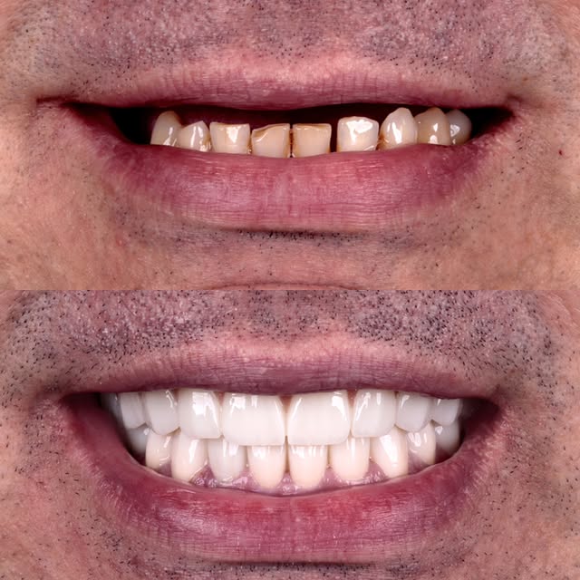 Full-mouth rehabilitation case ✨  This smile transformation was achieved through a comprehensive implant and prosthetic treatment plan designed to res