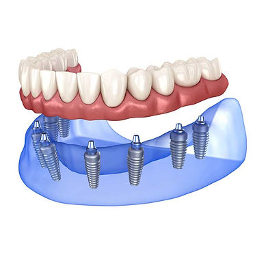 Dental Implants