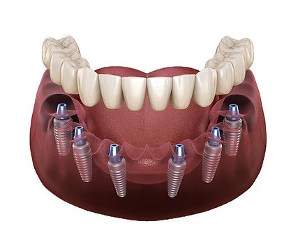 All on 6 Treatment