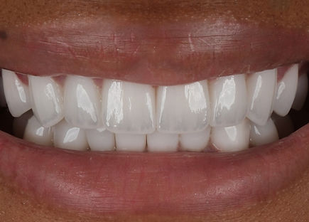 Zirconium Crowns