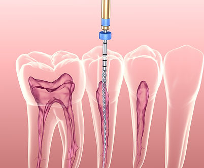 Root Canal Treatment