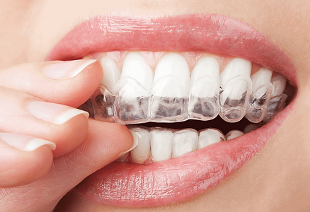 Invisalign Treatment